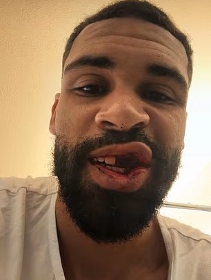 Loftus-Cheek Loses Several Teeth, Breaks Jaw After Collision With Parma Goalkeeper